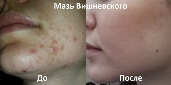 Результат лечения прыщей мазью Вишневского