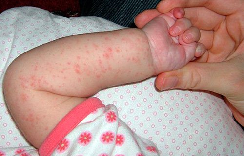 Аллергические высыпания у ребенка