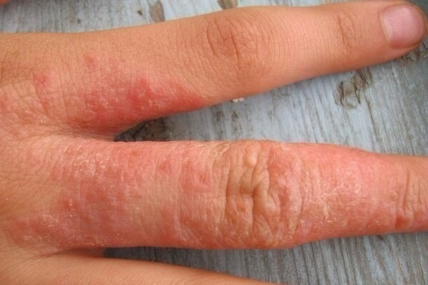Грибковый дерматит на руках