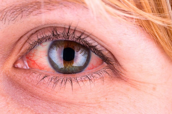 Глаз с аллергическим конъюнктивитом