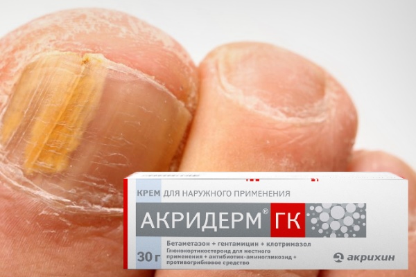 "Акридерм ГК" в лечении грибка ногтей