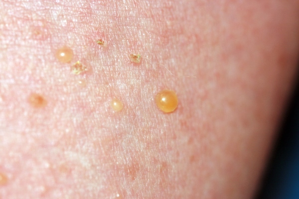 Буллезный дерматит на коже