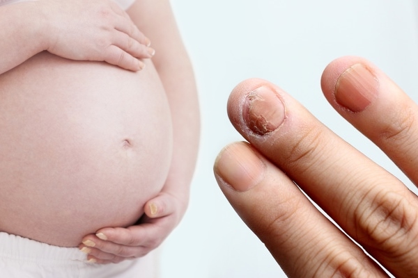 Грибок ногтей у беременной женщины