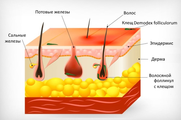 Развитие демодекоза на волосистой части головы