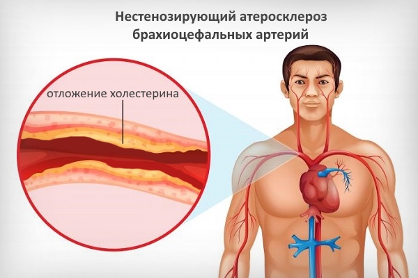 Нестенозирующий атеросклероз брахиоцефальных артерий
